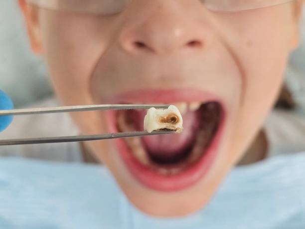 Best Emergency Tooth Extraction in Temple Hills, MD